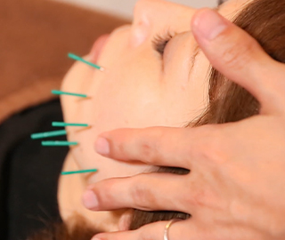 美容鍼施術の様子