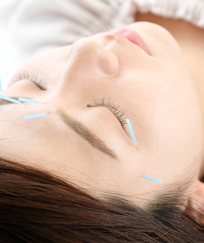 鍼を打って行なう治療